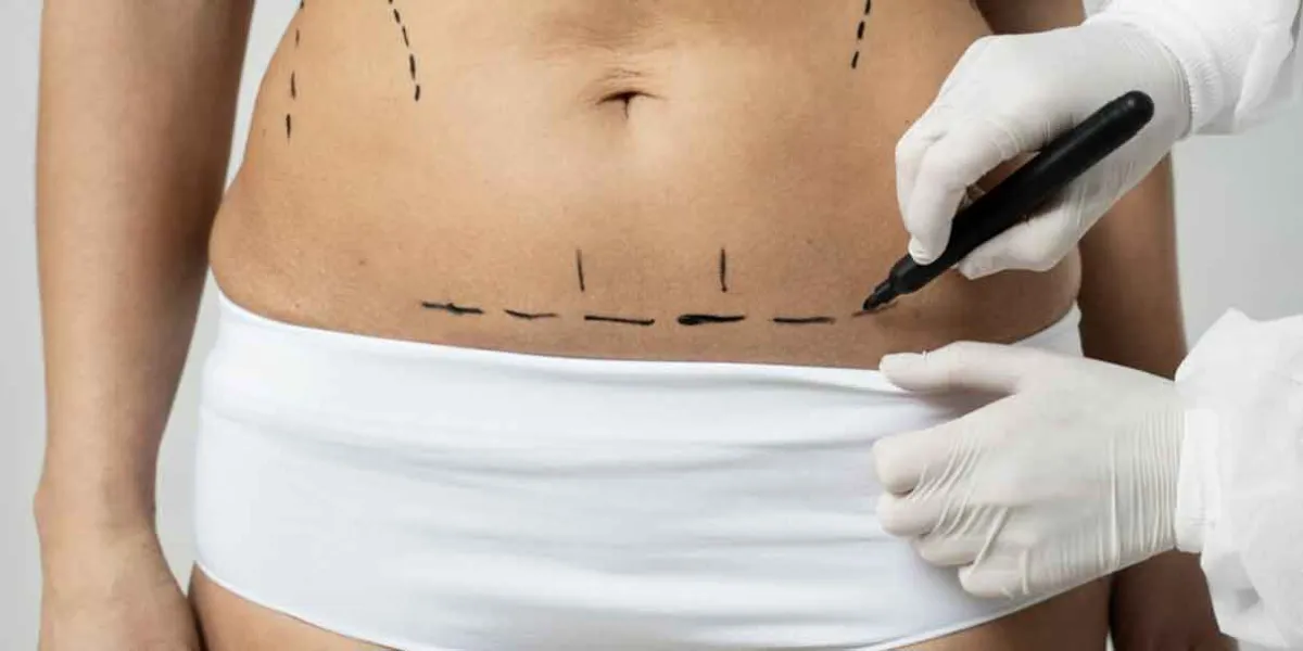 Congreso de Puebla busca frenar muertes por liposucciones mal practicadas