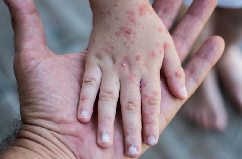 Brote de sarampión en México afecta ya a los 32 estados