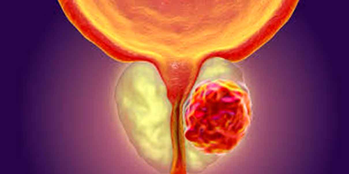 Cáncer de próstata