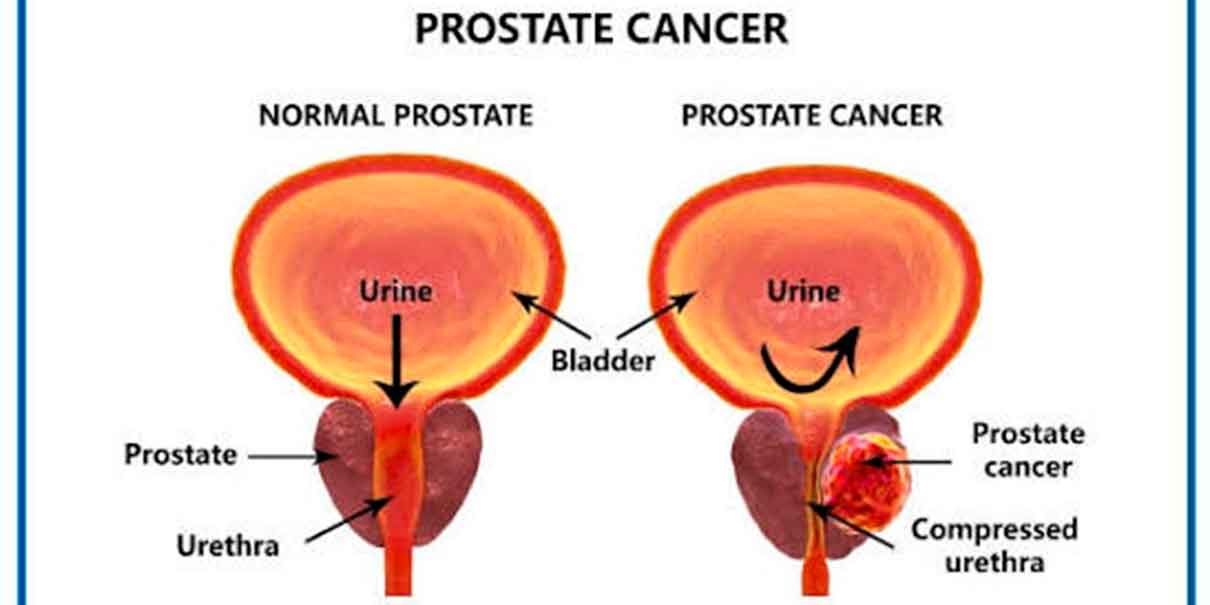 Cáncer de próstata