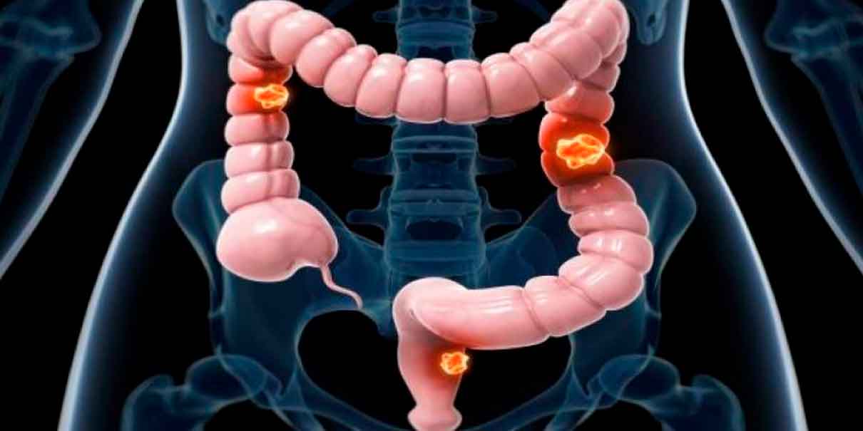 Cáncer colorrectal