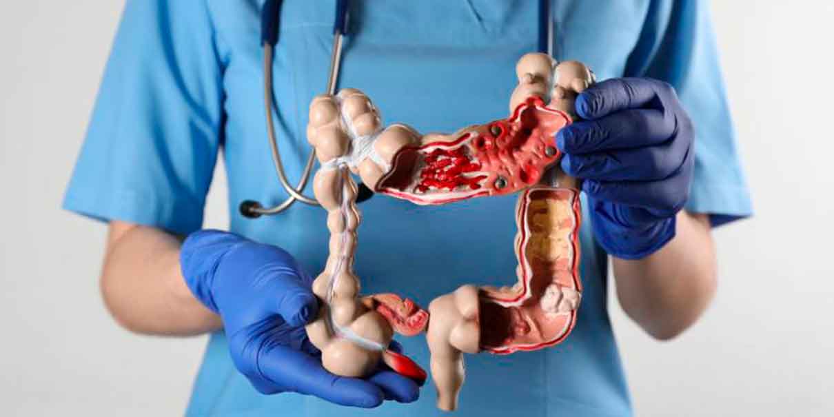 Cáncer de colon 