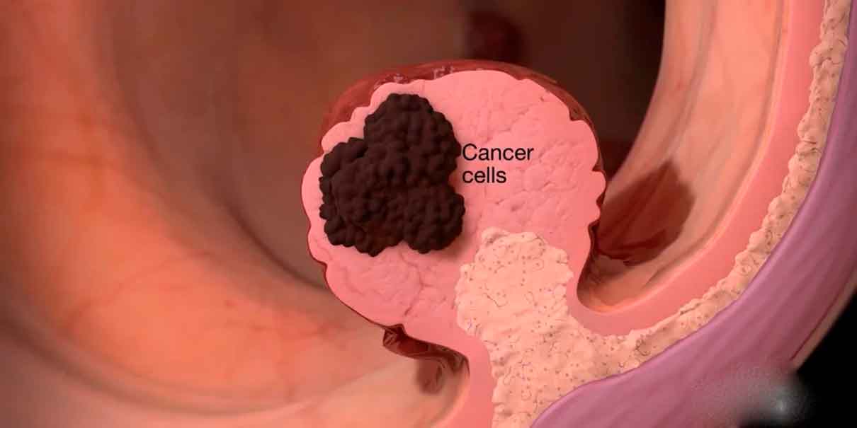 Cáncer de colon 