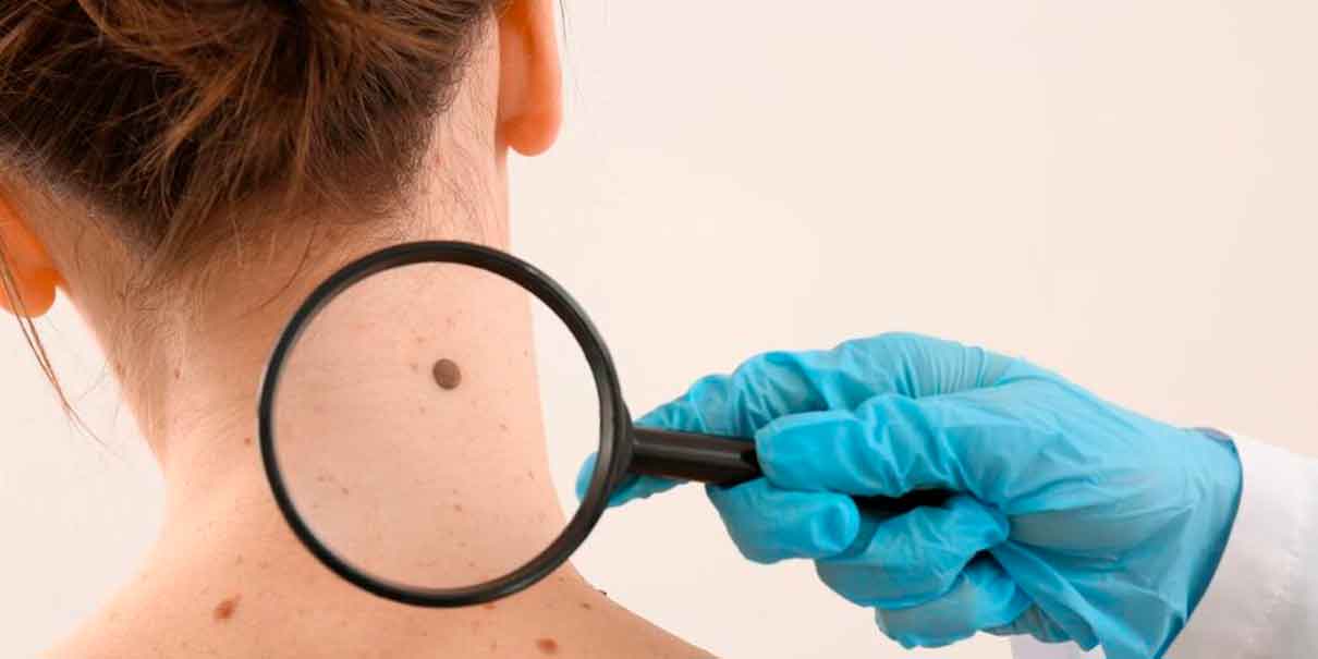 cáncer de piel