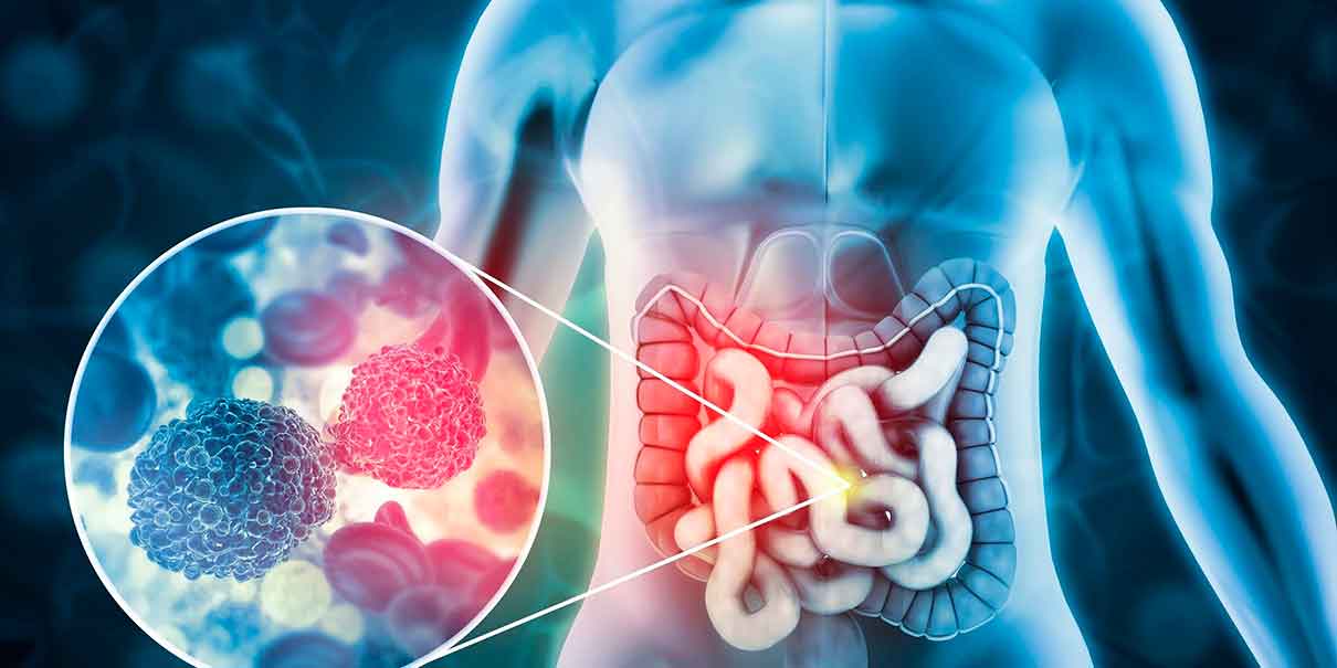Cáncer colorrectal