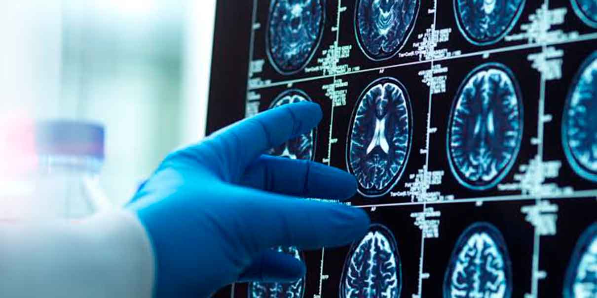 Cerebro