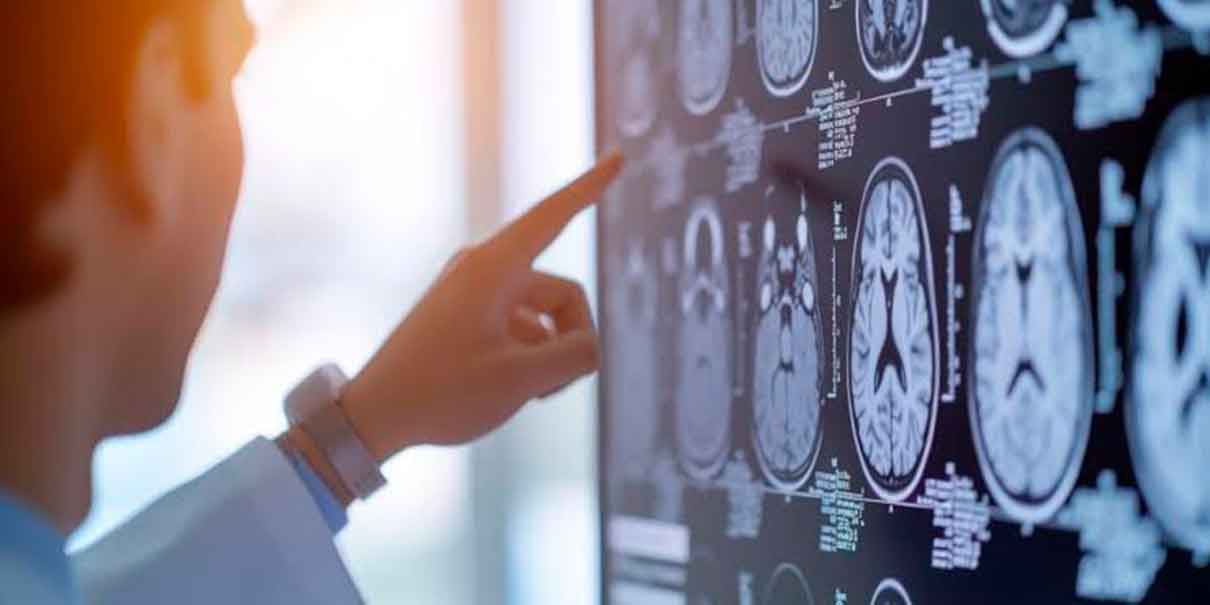 Prevención del accidente cerebrovascular