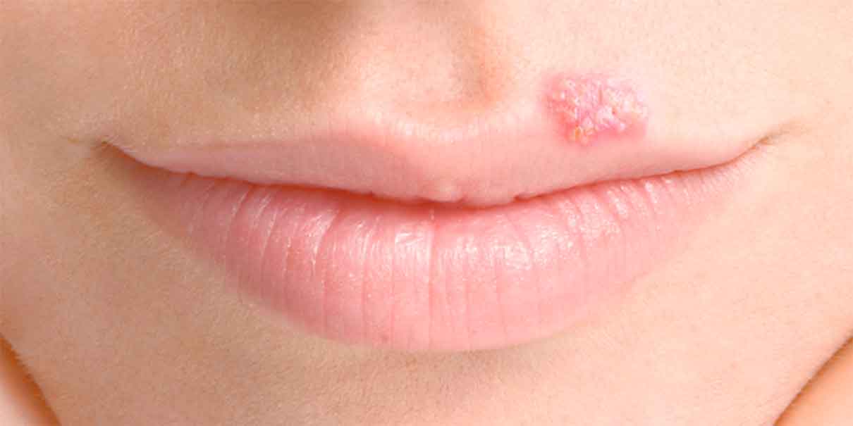 Herpes en la piel