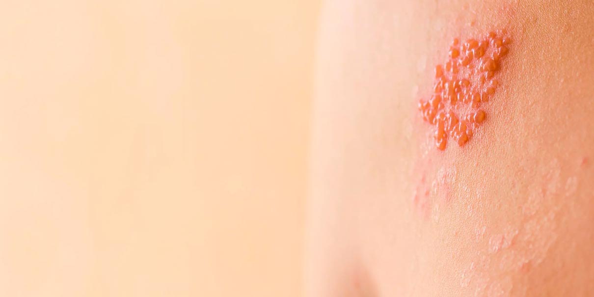 herpes zóster