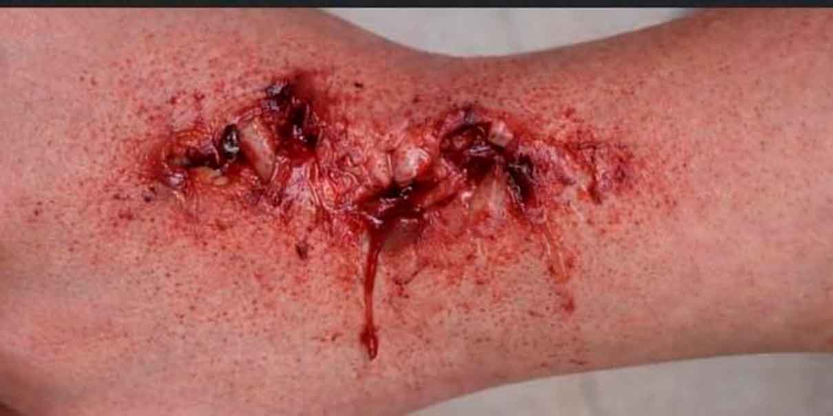 mordida de perro