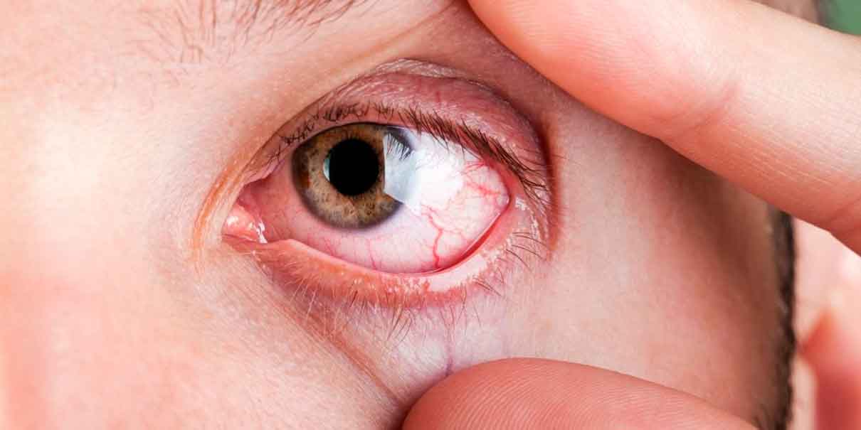 Ojo seco