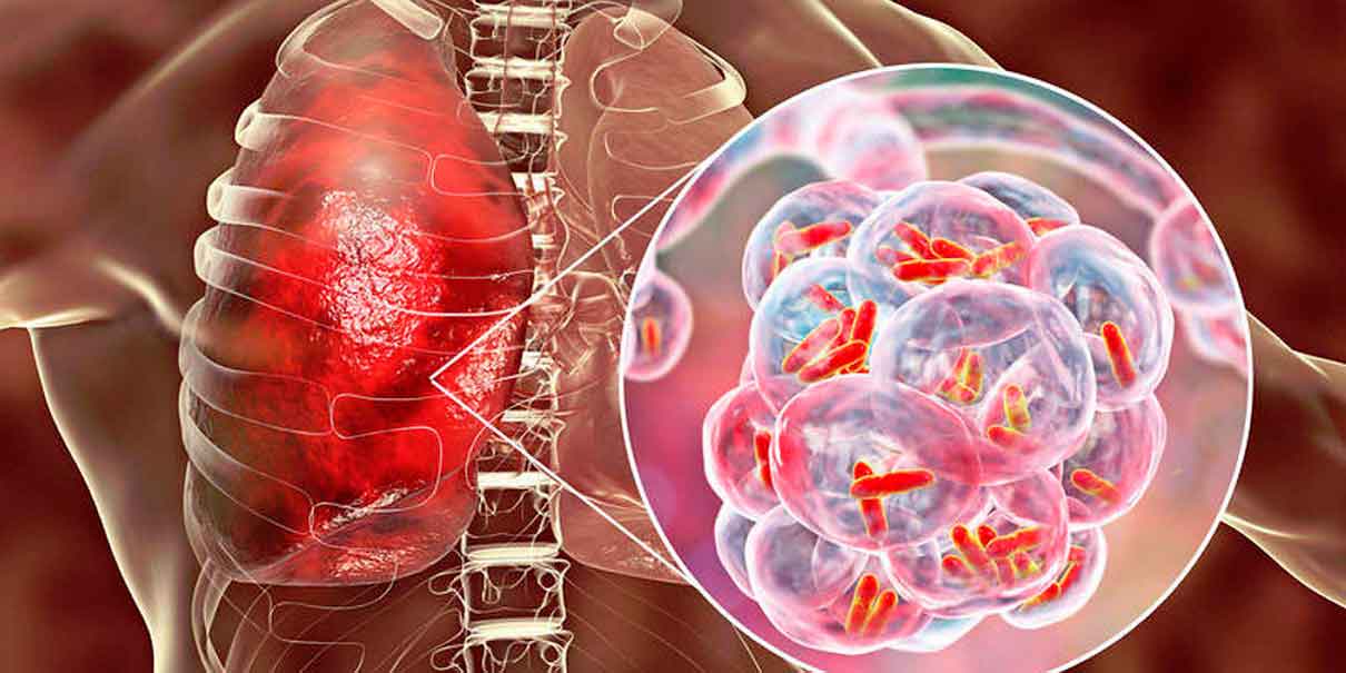 tuberculosis respiratoria