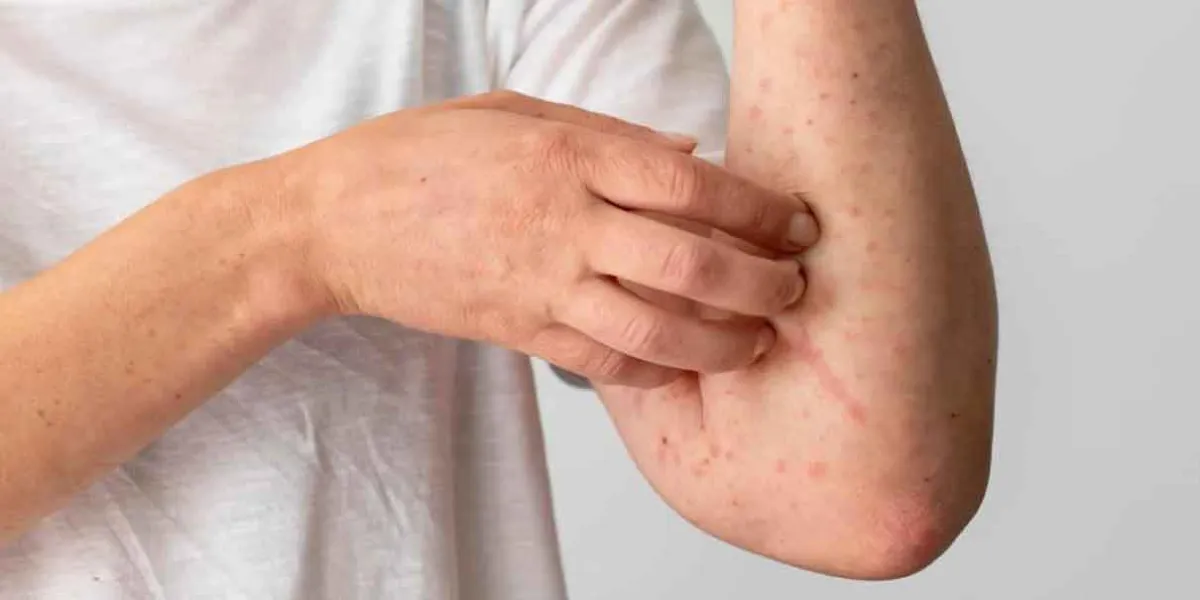 IMSS lanza cerco sanitario en San Jerónimo Coyula tras detectar casos de varicela y rubéola