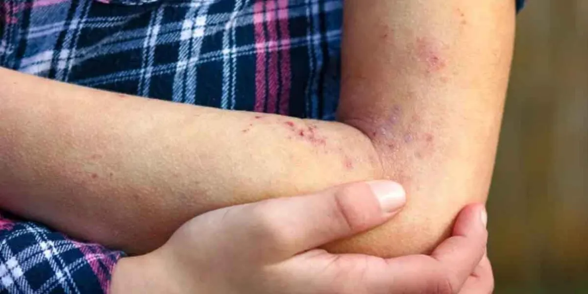 Enfermos de Lupus podrían recibir atención médica por ley
