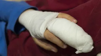 Aumentan riesgos de fracturas y quemaduras en niños durante vacaciones