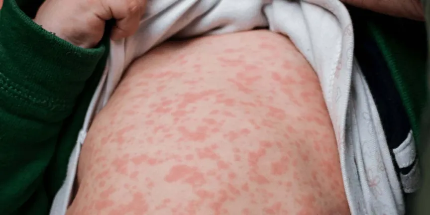 Brote de sarampión en México afecta ya a los 32 estados