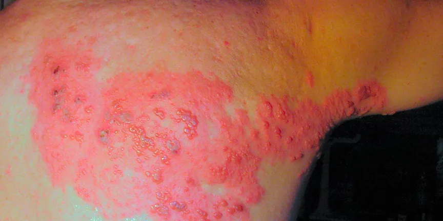Culebrilla: por qué el herpes zóster es más peligroso en personas con enfermedades crónicas