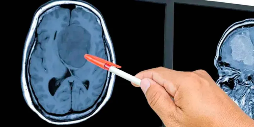 Testosterona podría ayudar a frenar el glioblastoma, según estudio 