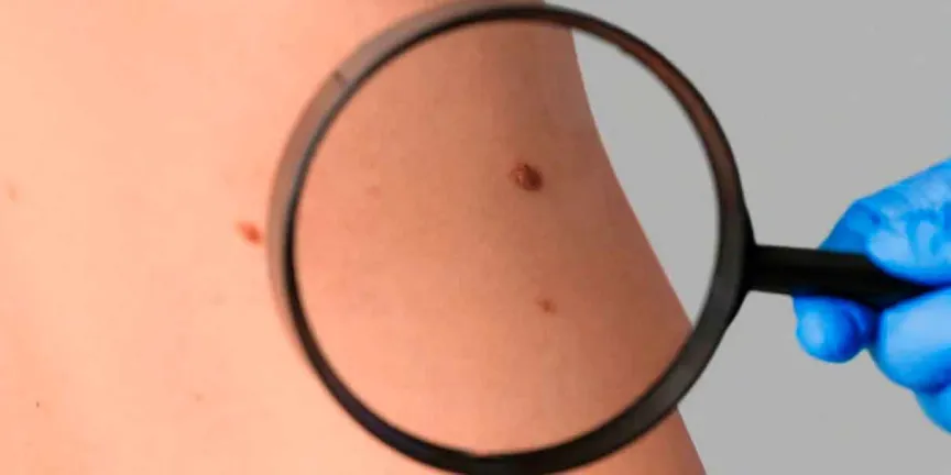 Cáncer de piel: cómo identificar un lunar peligroso y cuándo acudir al dermatólogo