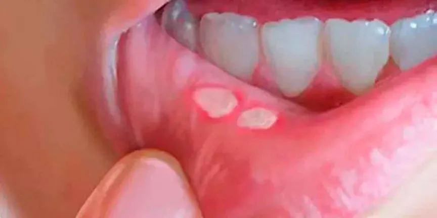 Sífilis: cómo identificar los síntomas, prevenir el contagio y recibir el tratamiento adecuado