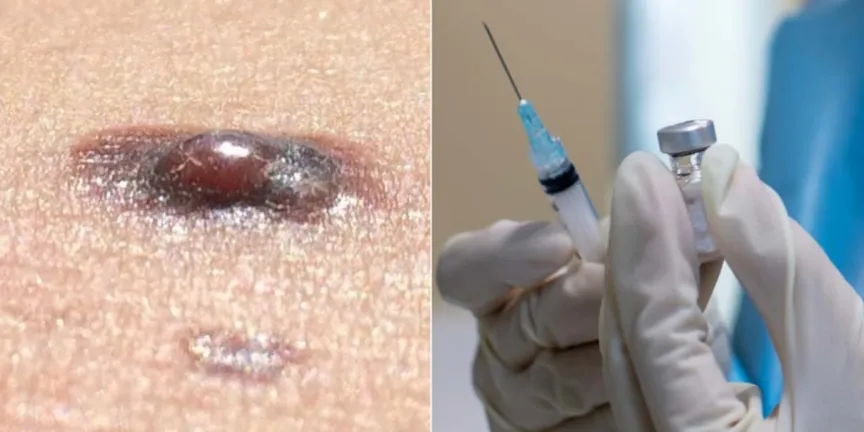 Así funciona la primera vacuna personalizada contra el cáncer de piel