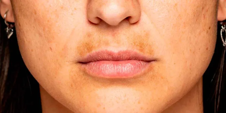 Manchas en el bigote: cómo aclarar el melasma sin dañar la piel